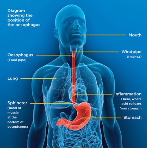 good-posture-helps-heartburn